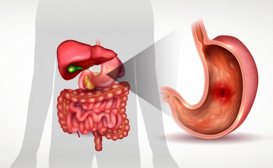 Úlcera Péptica
